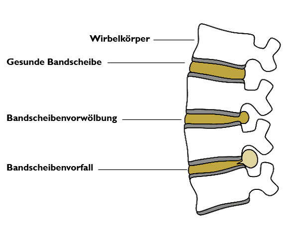 Illustration einer gesunden Bandscheibe im Vergleich zu einem Bandscheibenvorfall im unteren Rücken