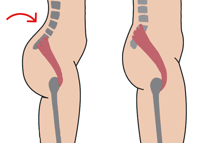 Ein anatomischer Vergleich des unteren Rückens und der Lendenwirbelsäule ist vereinfacht visualisiert. Verglichen wird ein gesunder Rücken mit einem Rücken, dessen verkürzte Hüftbeuger-Muskelgruppe Symptome wie ein Hohlkreuz verursacht.